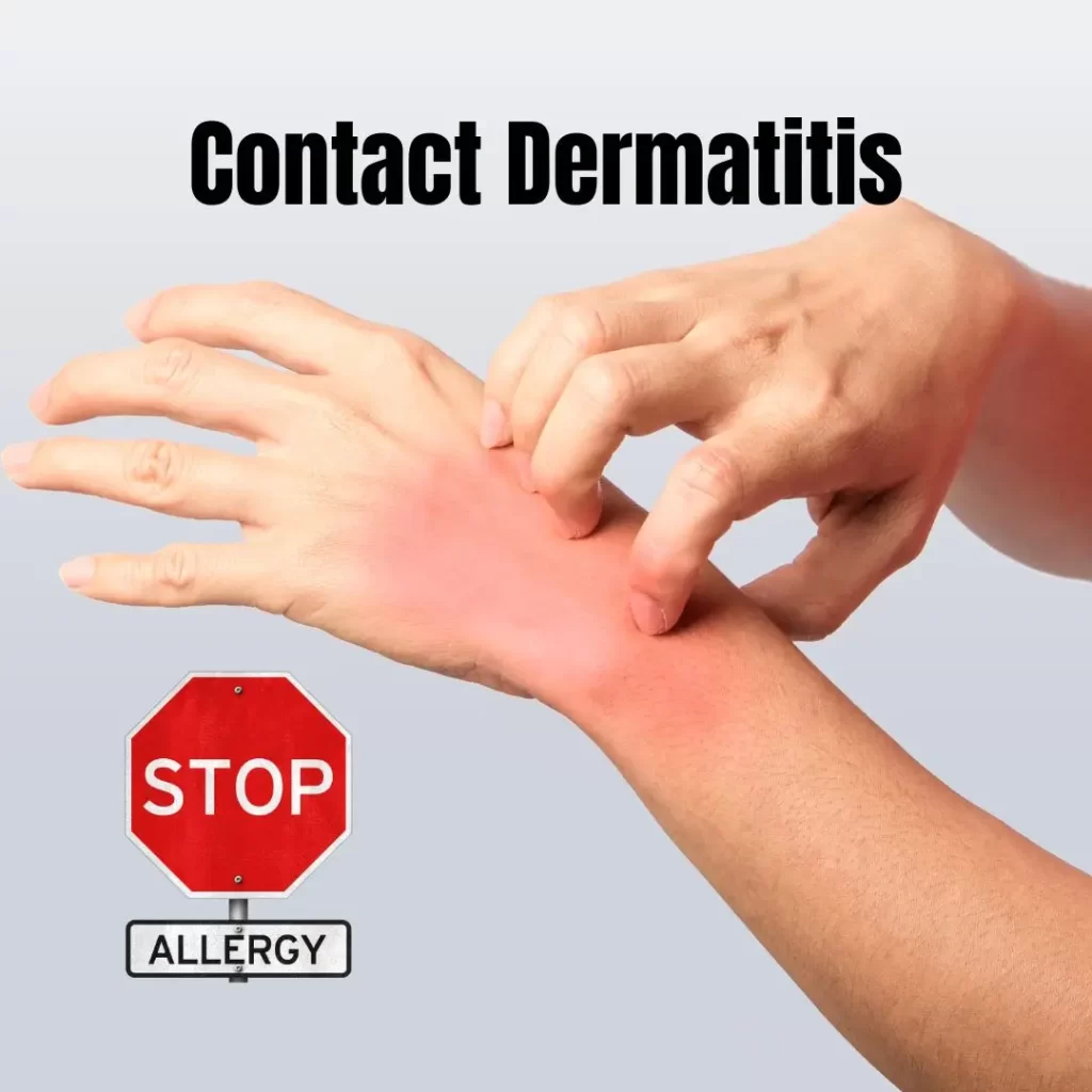 Kontaktni dermatitis kod nail tehničara: profesionalna bolest o kojoj se premalo govori 5 Kontaktni dermatitis kod nail tehničara
