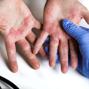 Kontaktni dermatitis kod nail tehničara