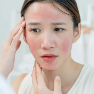 Kontaktni dermatitis kod nail tehničara