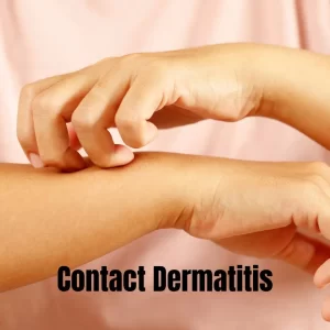 Kontaktni dermatitis kod nail tehničara